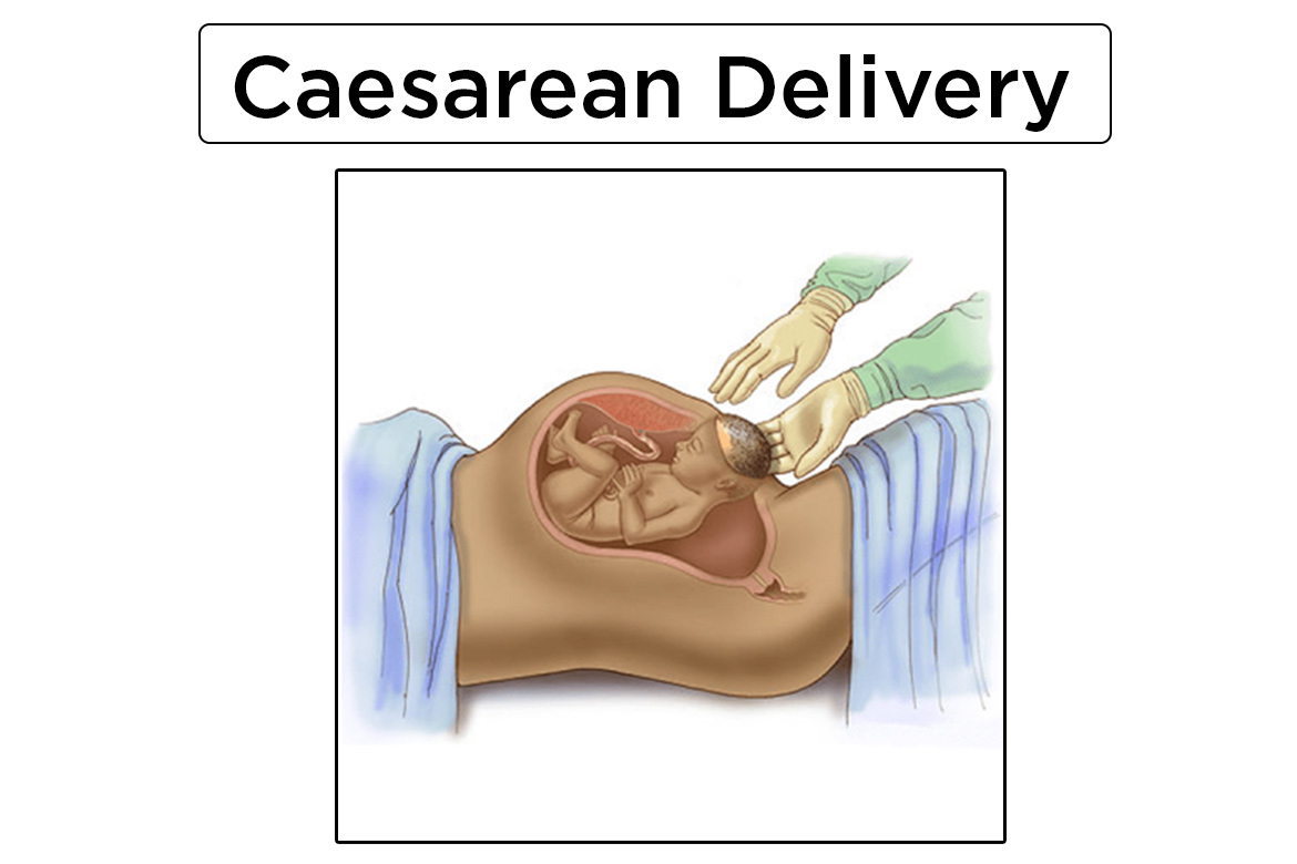 c section