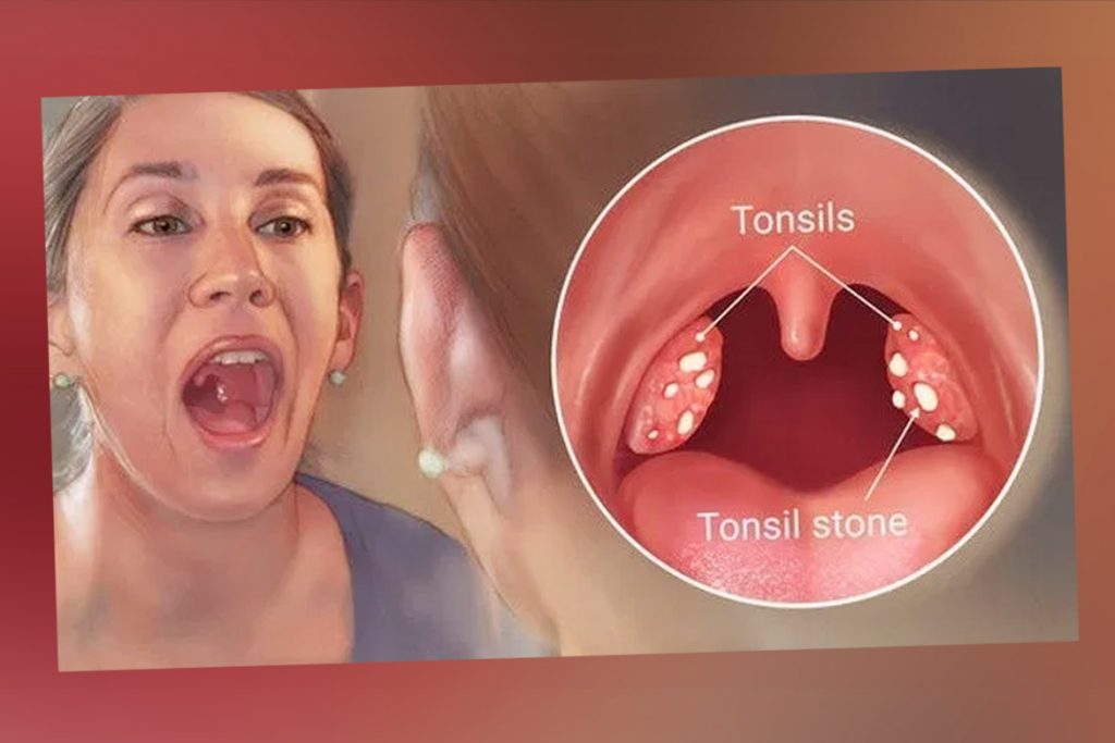 How to Remove Tonsil Stones You Cant See