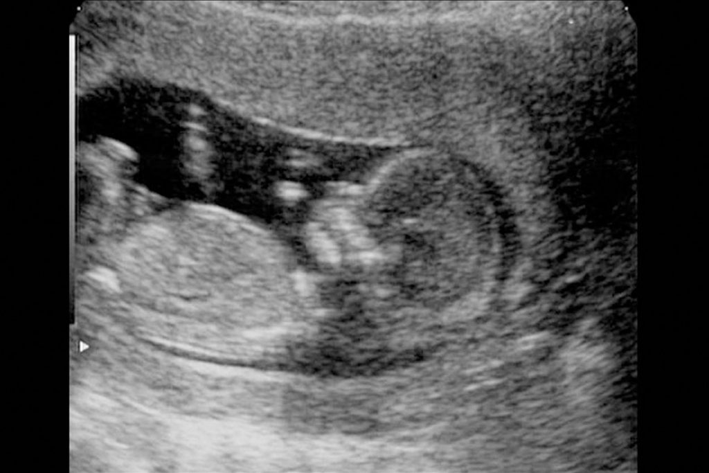 Ultrasound At 12th Week Of Pregnancy