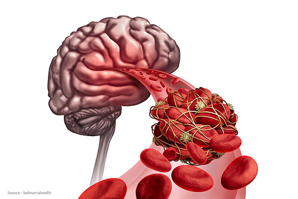 blood clots travel to brain
