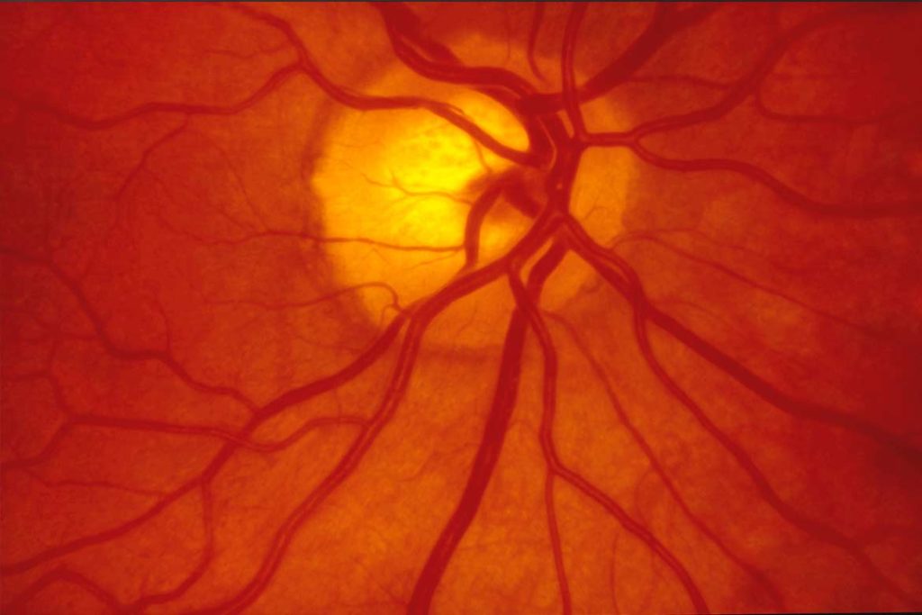 The Retina (ensures Healthy Vision)